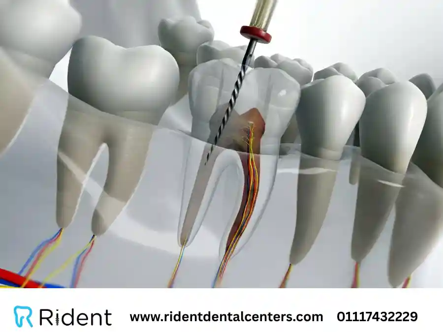 علاج التهاب الاعصاب للأسنان و8 أسباب قد تؤدي إليه احذر منها!